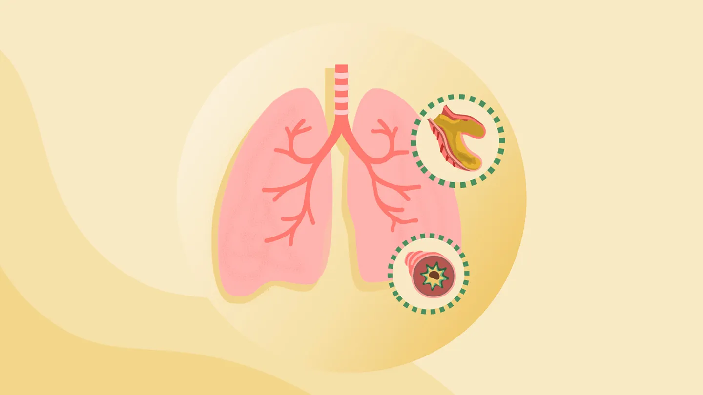 Bronchiectasis illustration