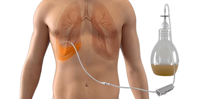 Chest Tube Insertion - Draining Fluid or Air from the Pleural Space