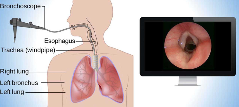Cryobiopsy procedures