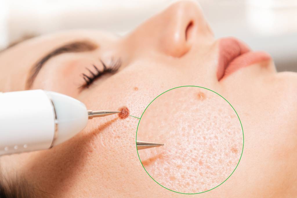 Electrocautery
