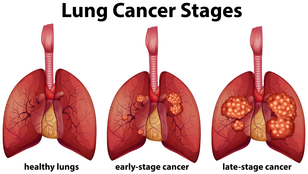 Lung cancer diagnosis scan