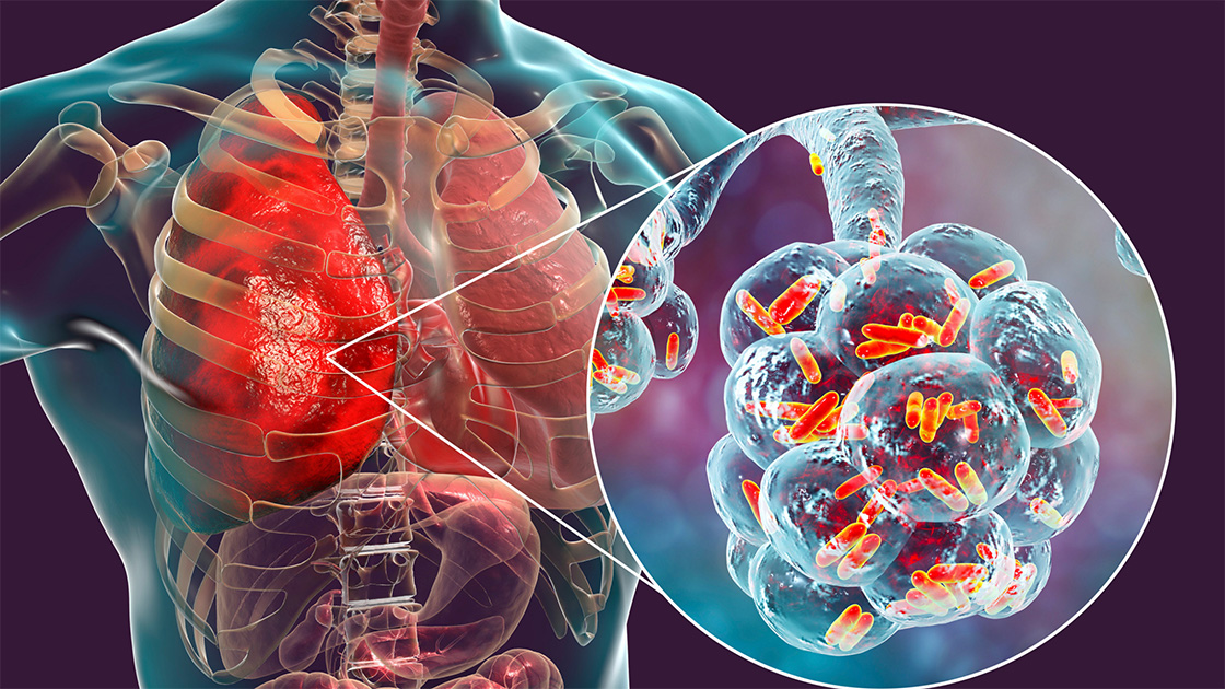 Lung infection treatment