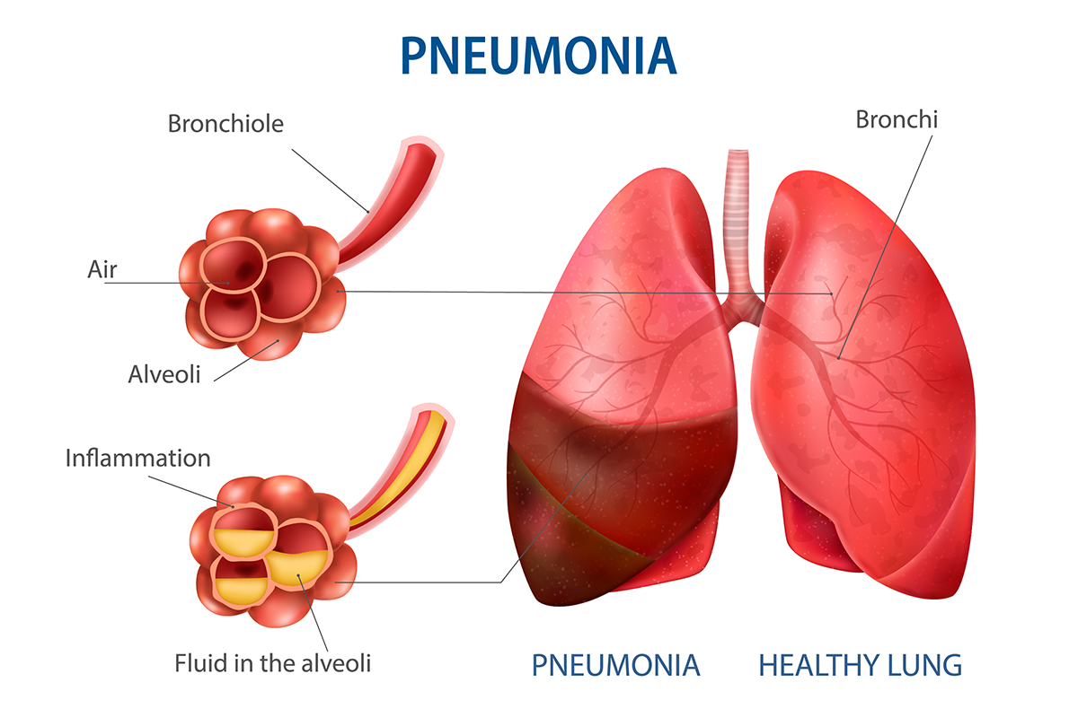 Pneumonia chest x-ray