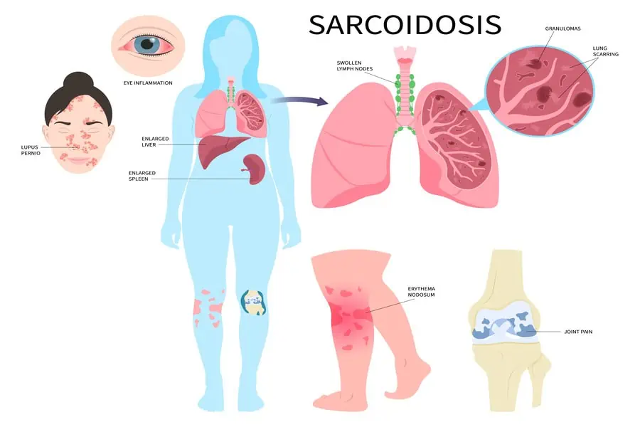 Sarcoidosis granuloma microscope