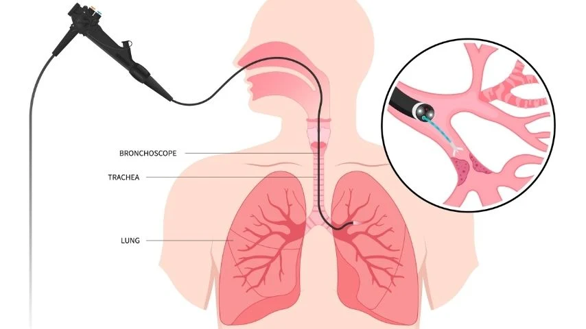 Tracheal stenting