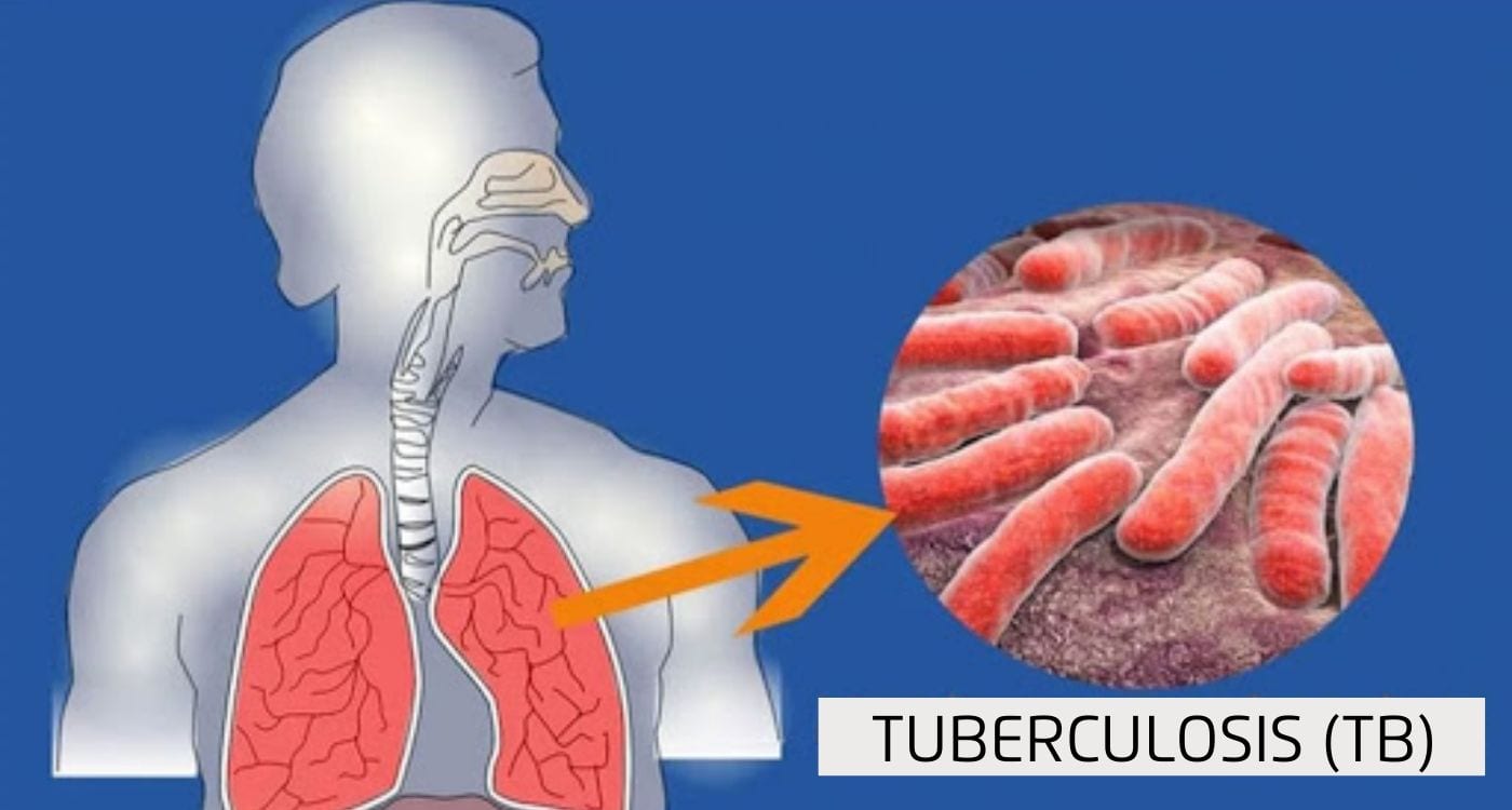 Tuberculosis chest x-ray